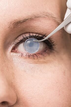 Corneal blindness is a global problem affecting over 12 million people